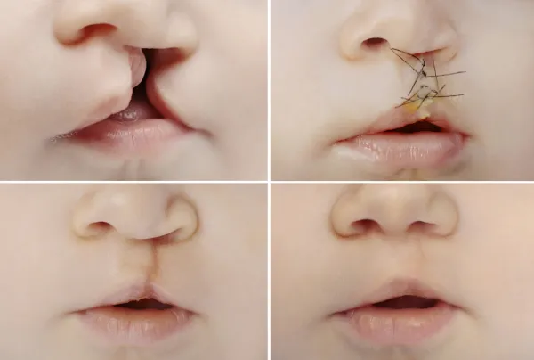 fentes labio-alveolo-palatines.jpg